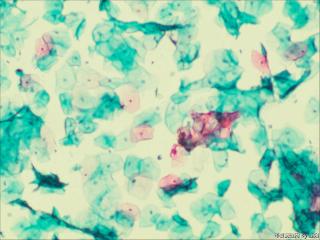 够ASC+HPV-DNA么？图14