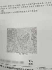 56岁子宫内膜活检，急求鉴定是否是透明细胞癌图1