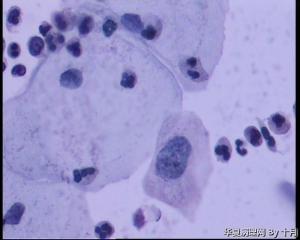 53岁，宫颈液基，LSILl?;   HSIL?图13