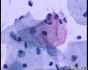 53岁，宫颈液基，LSILl?;   HSIL?图8
