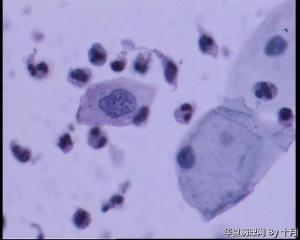 53岁，宫颈液基，LSILl?;   HSIL?图28
