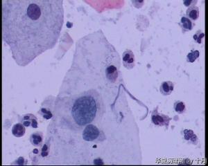 53岁，宫颈液基，LSILl?;   HSIL?图27