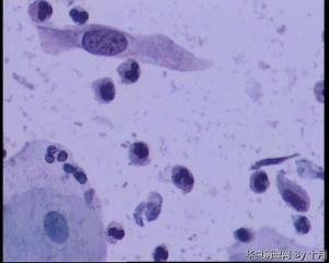 53岁，宫颈液基，LSILl?;   HSIL?图2