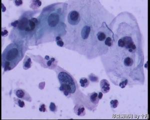 53岁，宫颈液基，LSILl?;   HSIL?图25