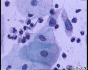 53岁，宫颈液基，LSILl?;   HSIL?图21