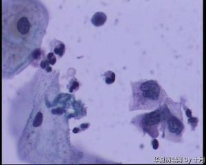 53岁，宫颈液基，LSILl?;   HSIL?图17
