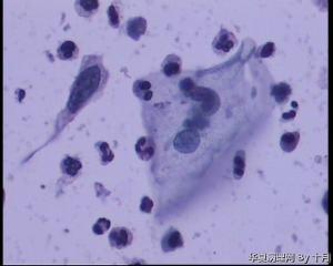 53岁，宫颈液基，LSILl?;   HSIL?图26