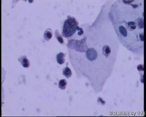 53岁，宫颈液基，LSILl?;   HSIL?图11
