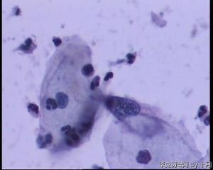 53岁，宫颈液基，LSILl?;   HSIL?图36