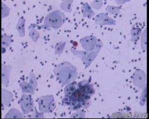53岁，宫颈液基，LSILl?;   HSIL?图30