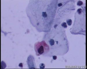53岁，宫颈液基，LSILl?;   HSIL?图19