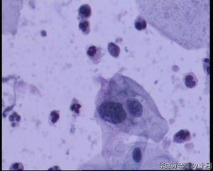 53岁，宫颈液基，LSILl?;   HSIL?图40