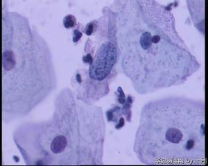 53岁，宫颈液基，LSILl?;   HSIL?图12