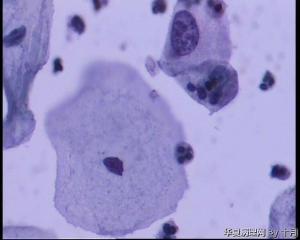 53岁，宫颈液基，LSILl?;   HSIL?图41