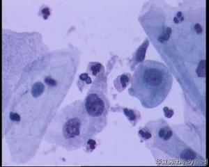 53岁，宫颈液基，LSILl?;   HSIL?图1