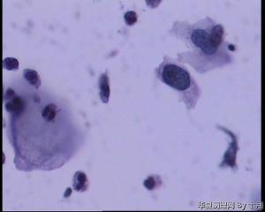 53岁，宫颈液基，LSILl?;   HSIL?图29