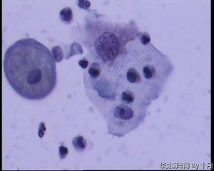 53岁，宫颈液基，LSILl?;   HSIL?图16