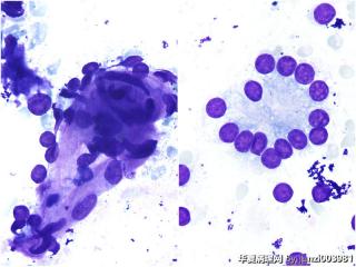 甲状腺穿刺，良性还是恶性？图25