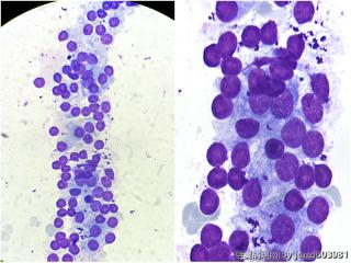 甲状腺穿刺，良性还是恶性？图21