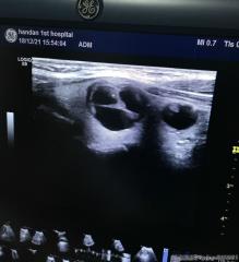 甲状腺穿刺，良性还是恶性？图2