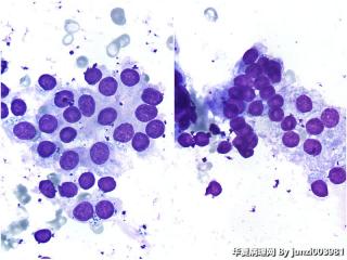 甲状腺穿刺，良性还是恶性？图26