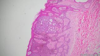 46y，男性腋下皮肤图1