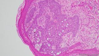 46y，男性腋下皮肤图7