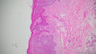 46y，男性腋下皮肤图3