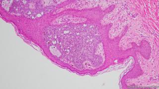 46y，男性腋下皮肤图6