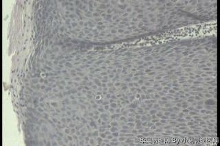 求助！请老师看看外阴灰白色颗粒状增生，是VIN III 累及皮肤附属器吗？图7