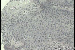求助！请老师看看外阴灰白色颗粒状增生，是VIN III 累及皮肤附属器吗？图12
