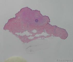 请老师们看看这个皮肤肿块图1