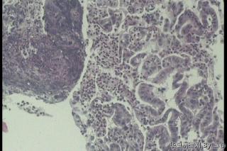 胃多发溃疡，腺体怎么这么小，零散，腺腔不规则？图1