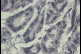 胃多发溃疡，腺体怎么这么小，零散，腺腔不规则？图10
