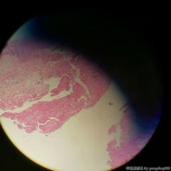 双侧声带新生物图1