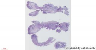 宫颈赘生物图1