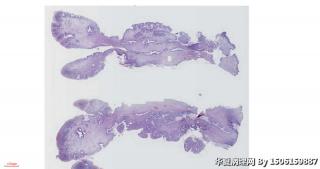 宫颈赘生物图2