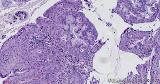 宫颈赘生物图13