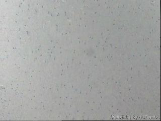 精索旁肿物图1