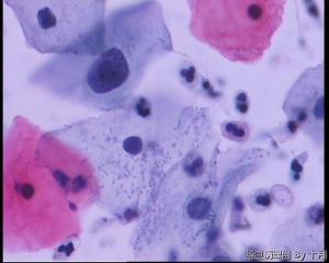 请教：38岁宫颈液基，够HSIL吗？图14