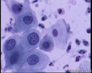 请教：38岁宫颈液基，够HSIL吗？图22