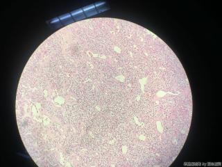 甲状腺包块图4