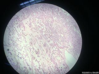 甲状腺包块图8