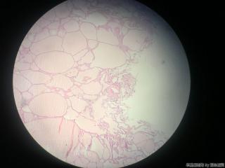 甲状腺包块图3