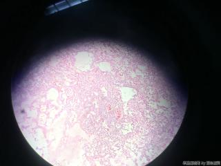甲状腺包块图5