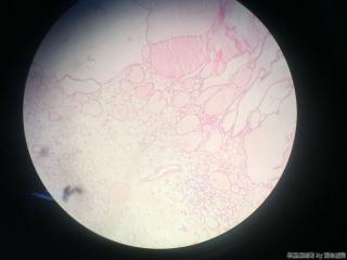 甲状腺包块图11