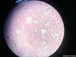 甲状腺包块图6
