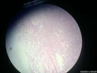 甲状腺包块图13