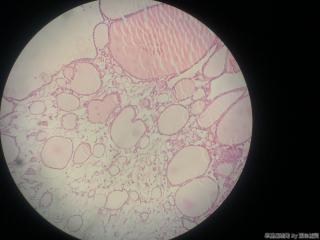 甲状腺包块图9