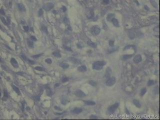 鼻背部肿物/皮脂腺癌？图15